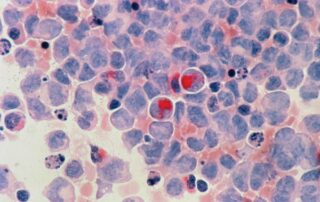 Leukemia cells under a microscope.