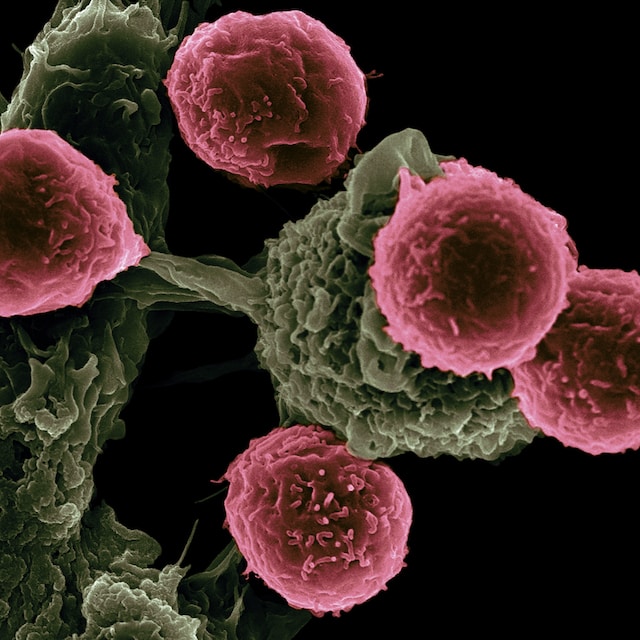 Microscopic view of cancer cells.